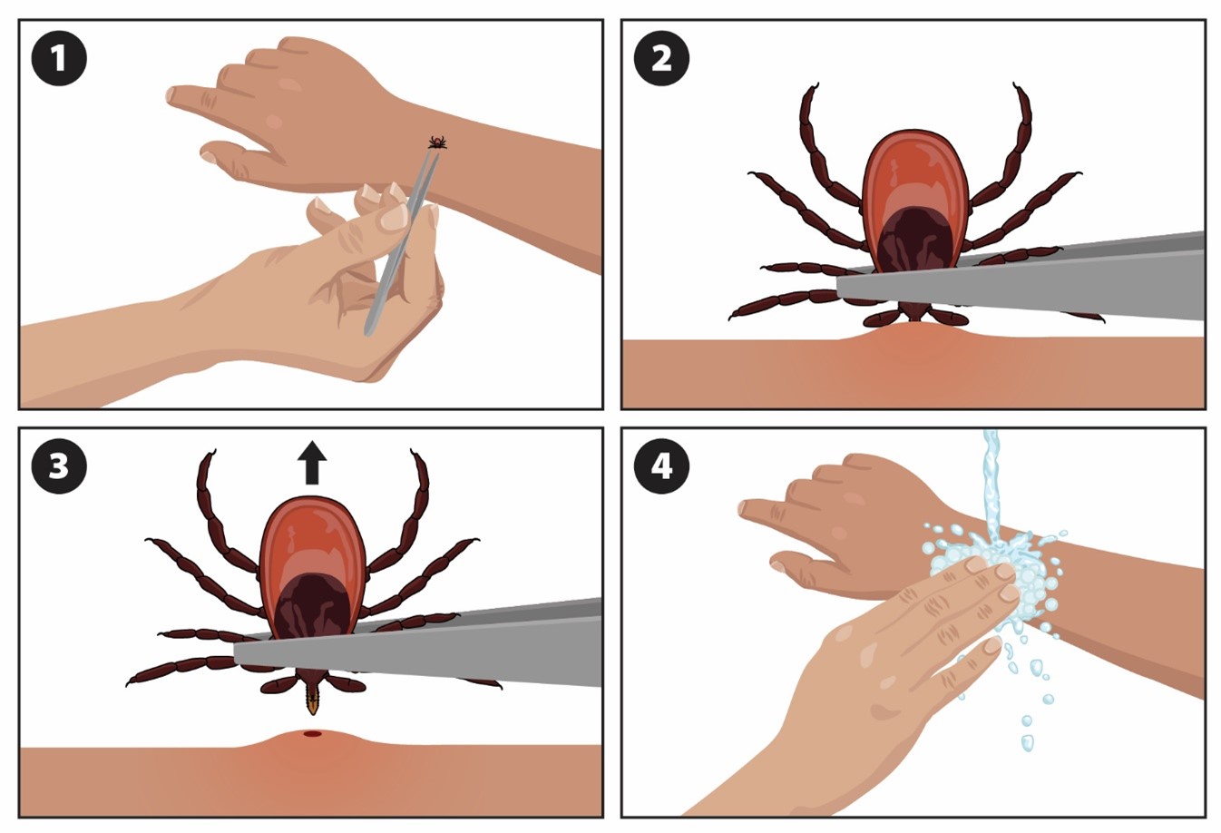 Four steps on how to remove a tick from your skin.
